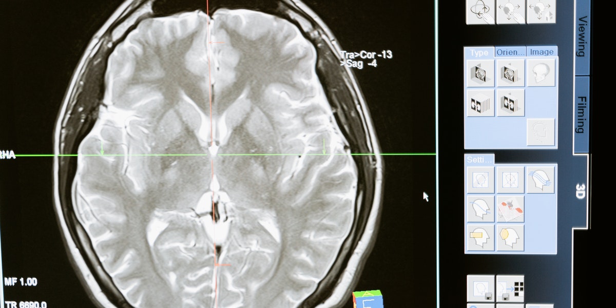 Neuroinflammation As A Possible Cause For Alzheimer’s